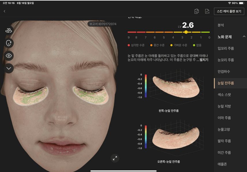 눈밑 잔주름 분석