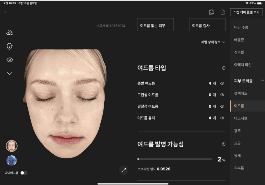 여드름 분석