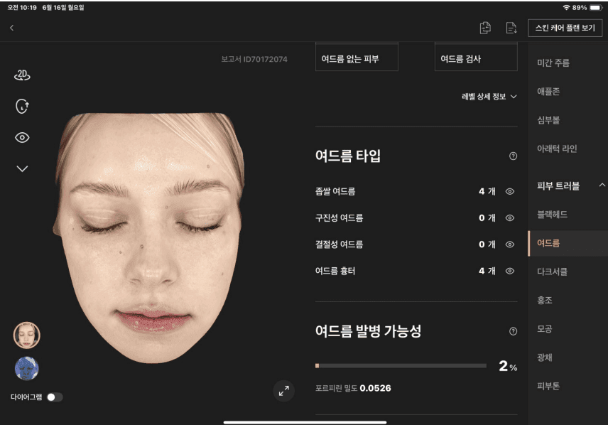 여드름 분석