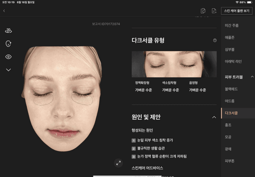 다크서클 분석