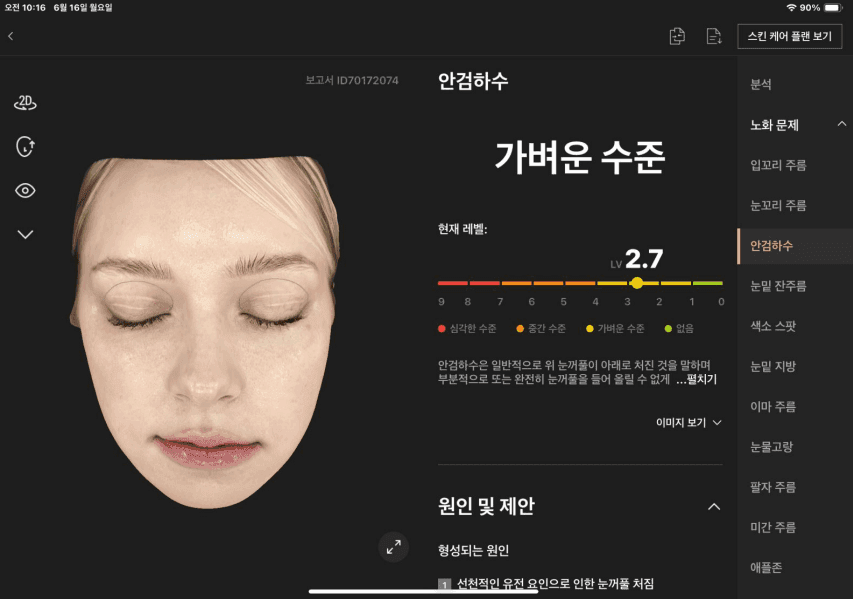 안검하수 분석