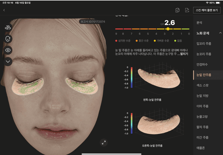 눈밑 잔주름 분석