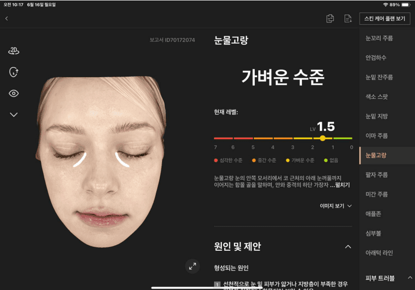 눈물고랑 분석