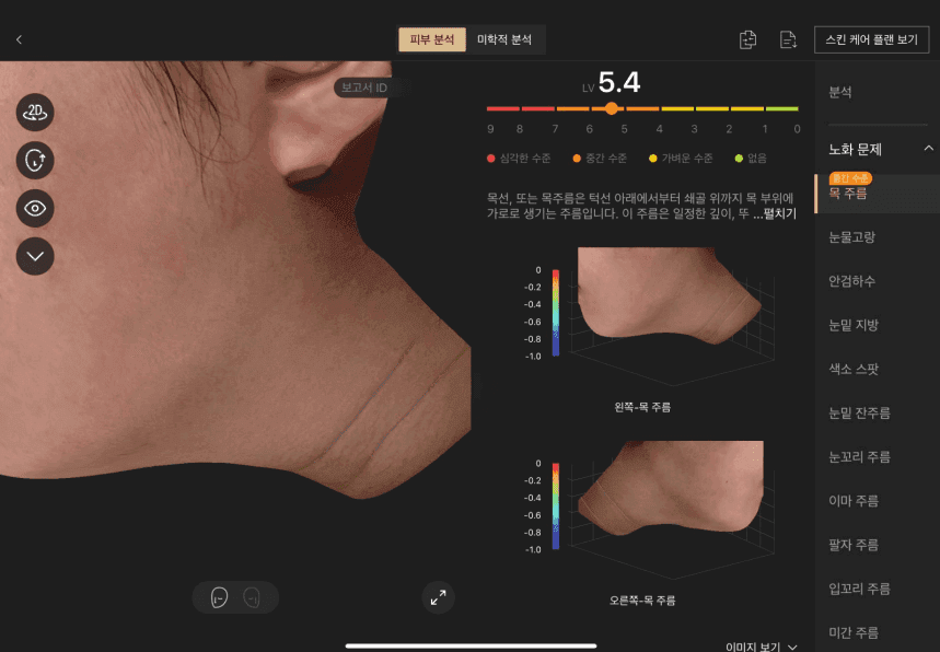 목주름 분석